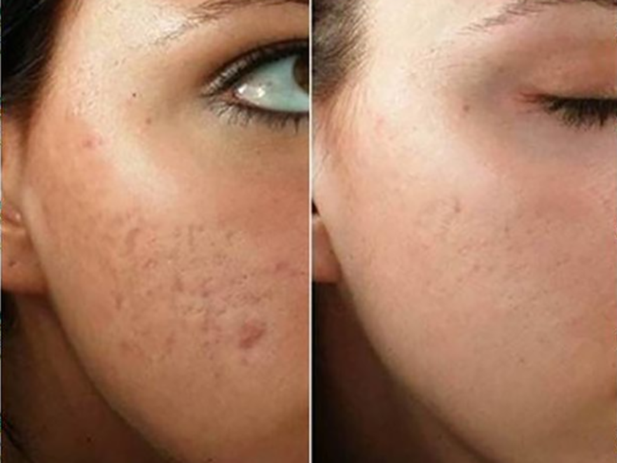 Keter_Medical_Center___Spa_Facial_Treatments_ PRP_b___a_01
