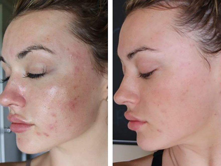 Keter_Medical_Center___Spa_Facial_Treatments_ PRP_b___a_02