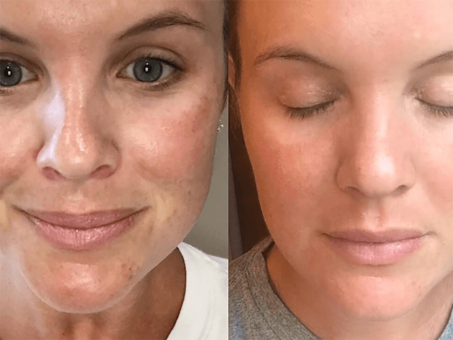 Keter_Medical_Center___Spa_Facial_Treatments_ PRP_b___a_03
