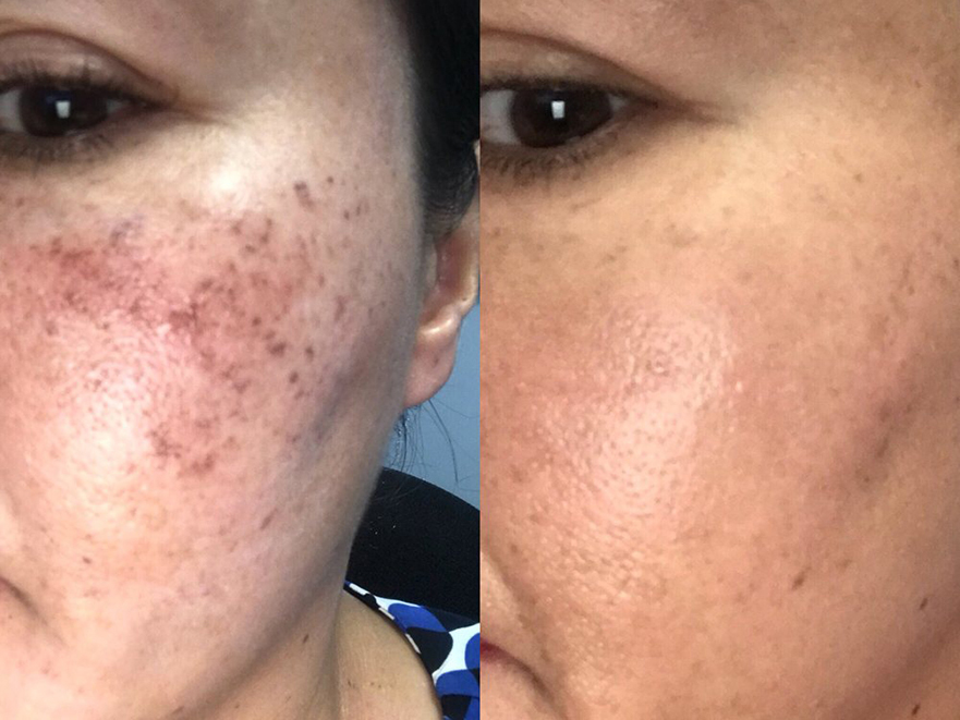 Keter_Medical_Center___Spa_Facial_Treatments_ PRP_b___a_04