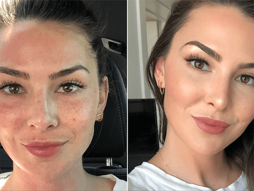 Keter_Medical_Center___Spa_Facial_Treatments_ PRP_b___a_05