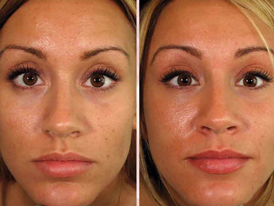 Keter_Medical_Center___Spa_Facial_Treatments_ PRP_b___a_06