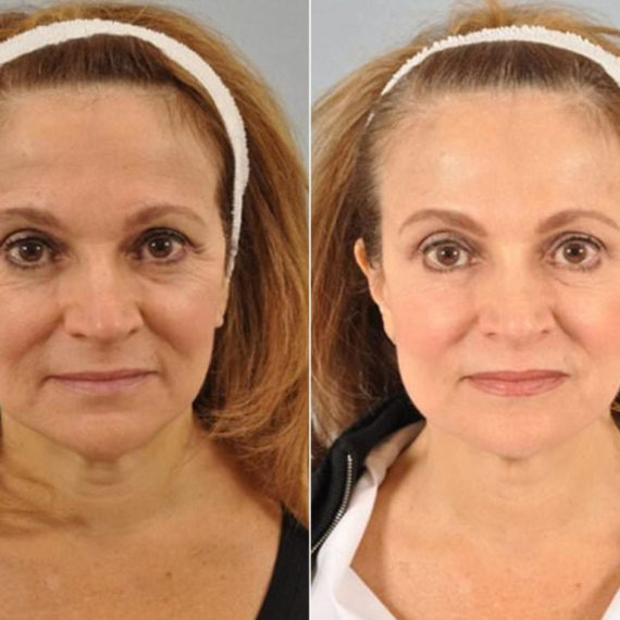Keter_Medical_Center___Spa_Facial_Treatments_fillers___injectables_b_a_01