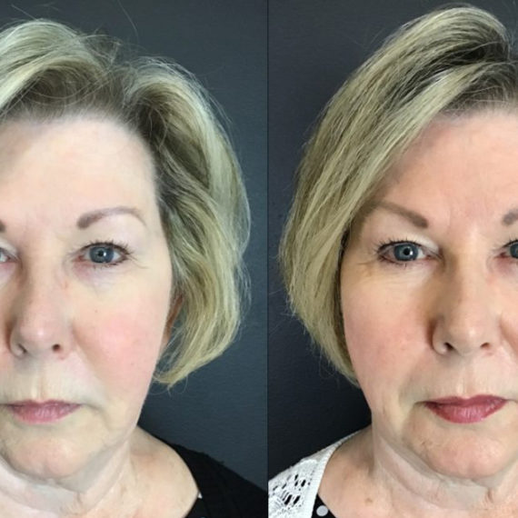 Keter_Medical_Center___Spa_Facial_Treatments_fillers___injectables_b_a_02