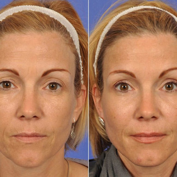 Keter_Medical_Center___Spa_Facial_Treatments_fillers___injectables_b_a_03