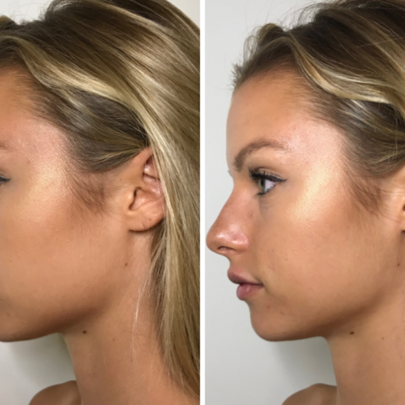 Keter_Medical_Center___Spa_Facial_Treatments_fillers___injectables_b_a_04