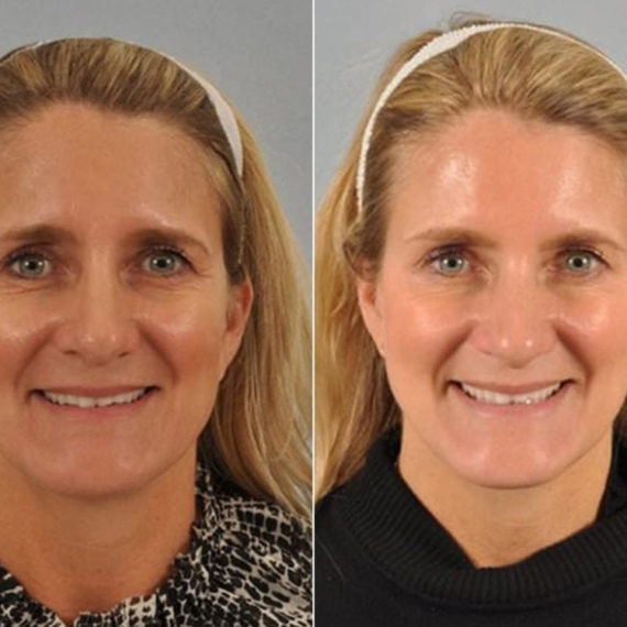 Keter_Medical_Center___Spa_Facial_Treatments_fillers___injectables_b_a_06