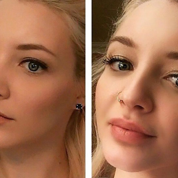 Keter_Medical_Center___Spa_Facial_Treatments_fillers___injectables_b_a_07