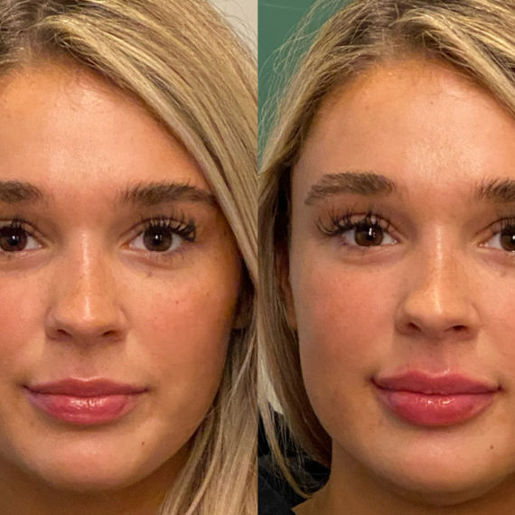 Keter_Medical_Center___Spa_Facial_Treatments_fillers___injectables_b_a_08