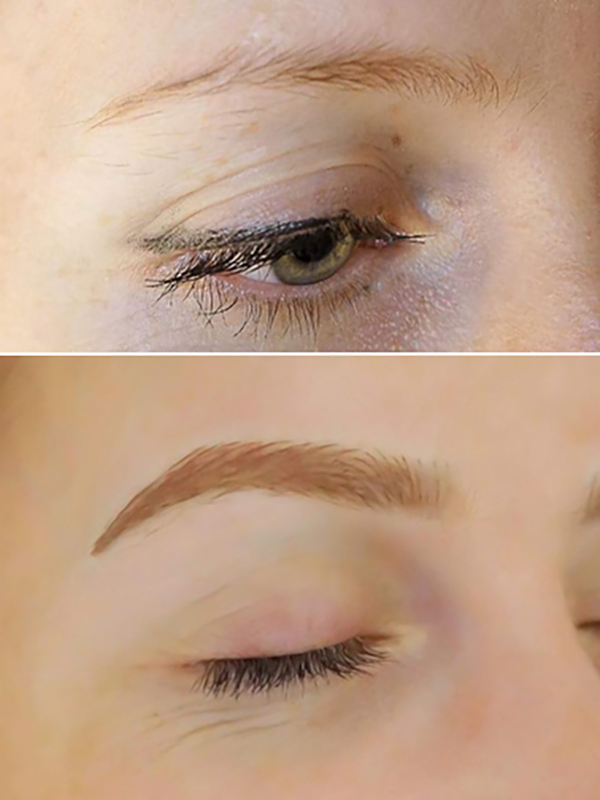 Keter_Medical_Center___Spa_Facial_Treatments_microblanding_b___a_01