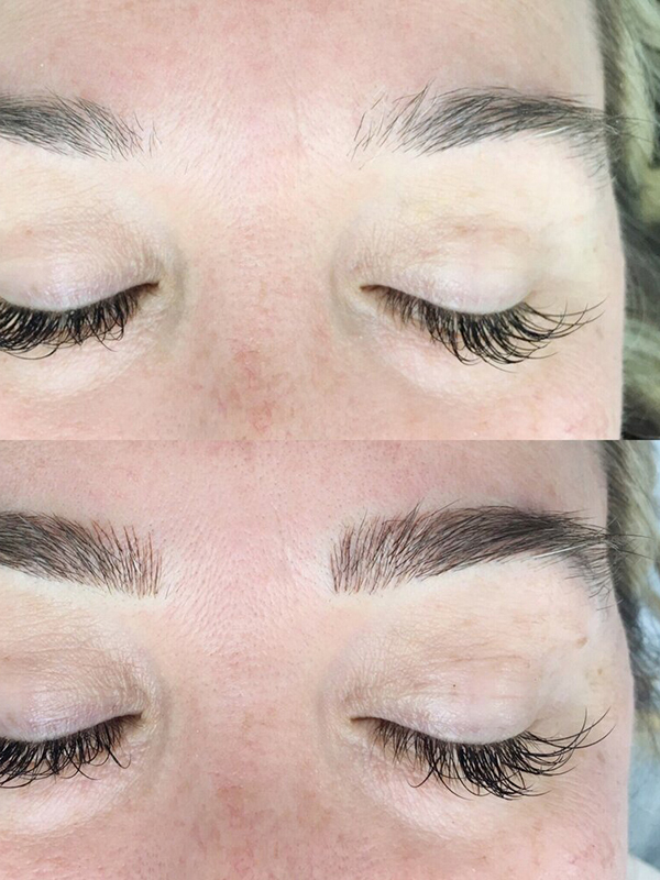 Keter_Medical_Center___Spa_Facial_Treatments_microblanding_b___a_02