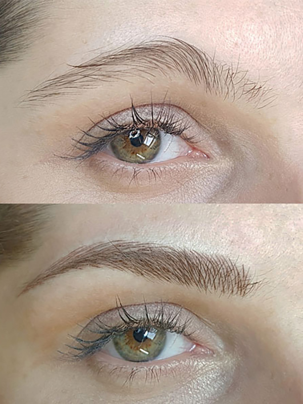 Keter_Medical_Center___Spa_Facial_Treatments_microblanding_b___a_03