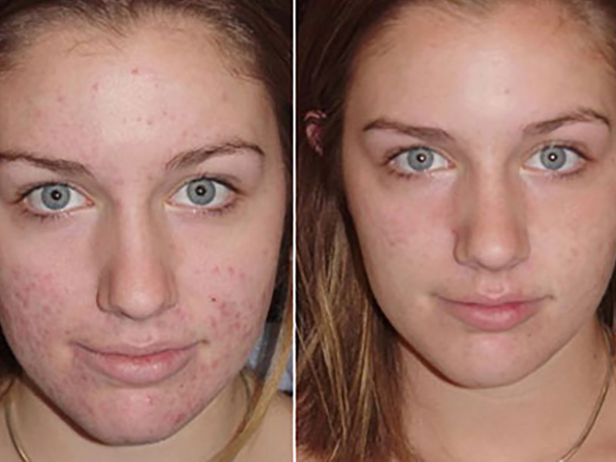Keter_Medical_Center___Spa_Facial_Treatments_microdermabrasion_b___a_01