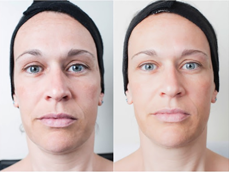 Keter_Medical_Center___Spa_Facial_Treatments_microdermabrasion_b___a_02