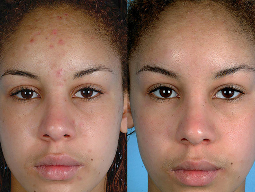 Keter_Medical_Center___Spa_Facial_Treatments_microdermabrasion_b___a_03