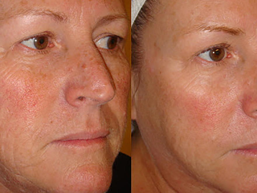 Keter_Medical_Center___Spa_Facial_Treatments_microdermabrasion_b___a_04