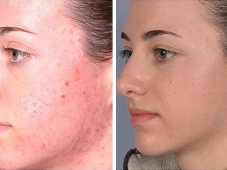 Keter_Medical_Center___Spa_Facial_Treatments_microdermabrasion_b___a_05