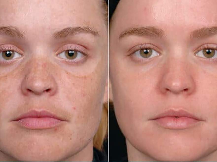 Keter_Medical_Center___Spa_Facial_Treatments_microdermabrasion_b___a_06