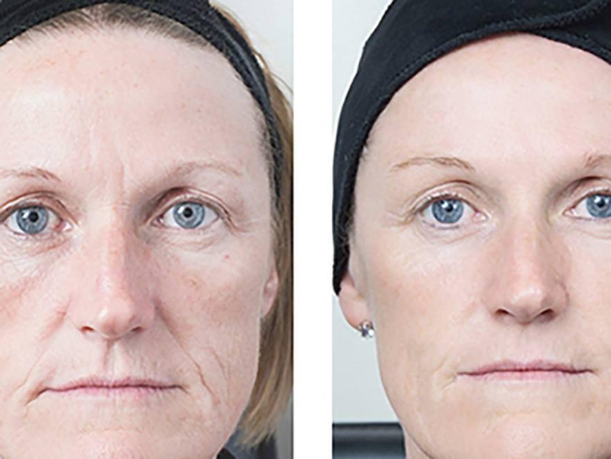 Keter_Medical_Center___Spa_Facial_Treatments_microdermabrasion_b___a_07