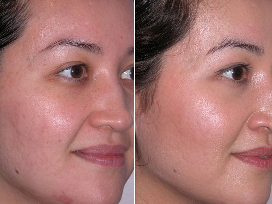 Keter_Medical_Center___Spa_Facial_Treatments_microdermabrasion_b___a_08