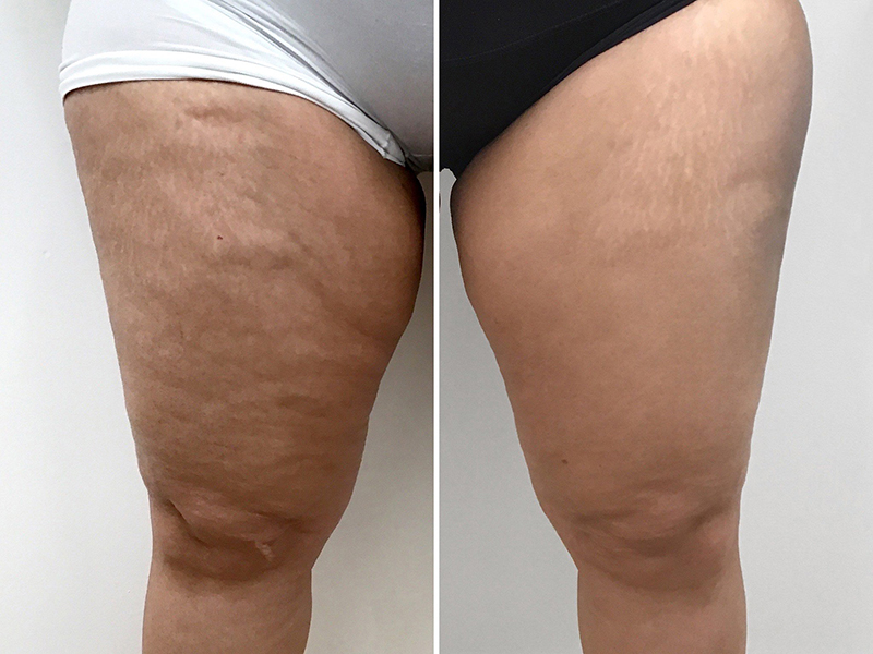 Keter_Medical_Center___Spa_body_Treatments_ b___a_01