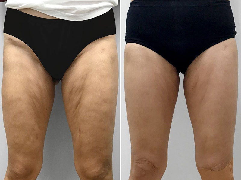 Keter_Medical_Center___Spa_body_Treatments_ b___a_03