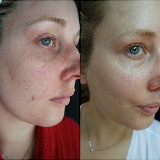 Keter_medical_center___spa_Microneedling_b_a_01