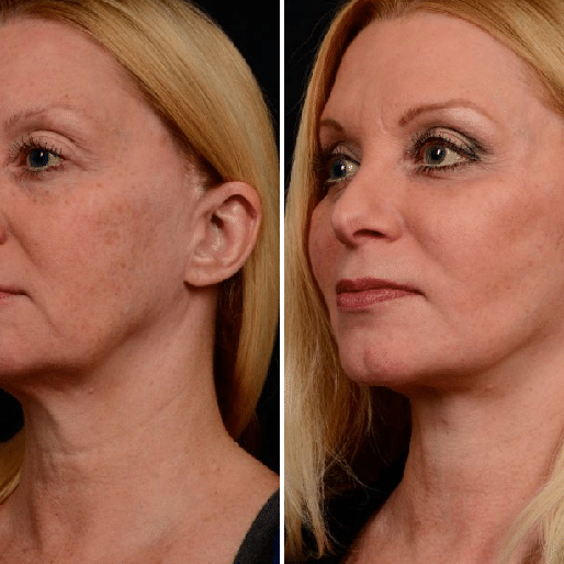 Keter_medical_center___spa_Microneedling_b_a_02