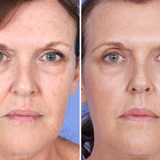 Keter_medical_center___spa_Microneedling_b_a_03