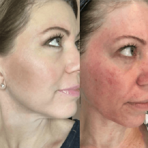 Keter_medical_center___spa_Microneedling_b_a_04
