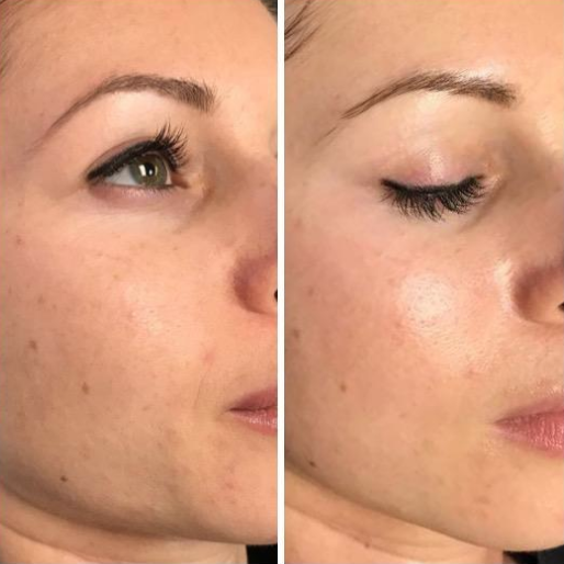 Keter_medical_center___spa_Microneedling_b_a_05